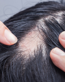 Alopecia avanzada